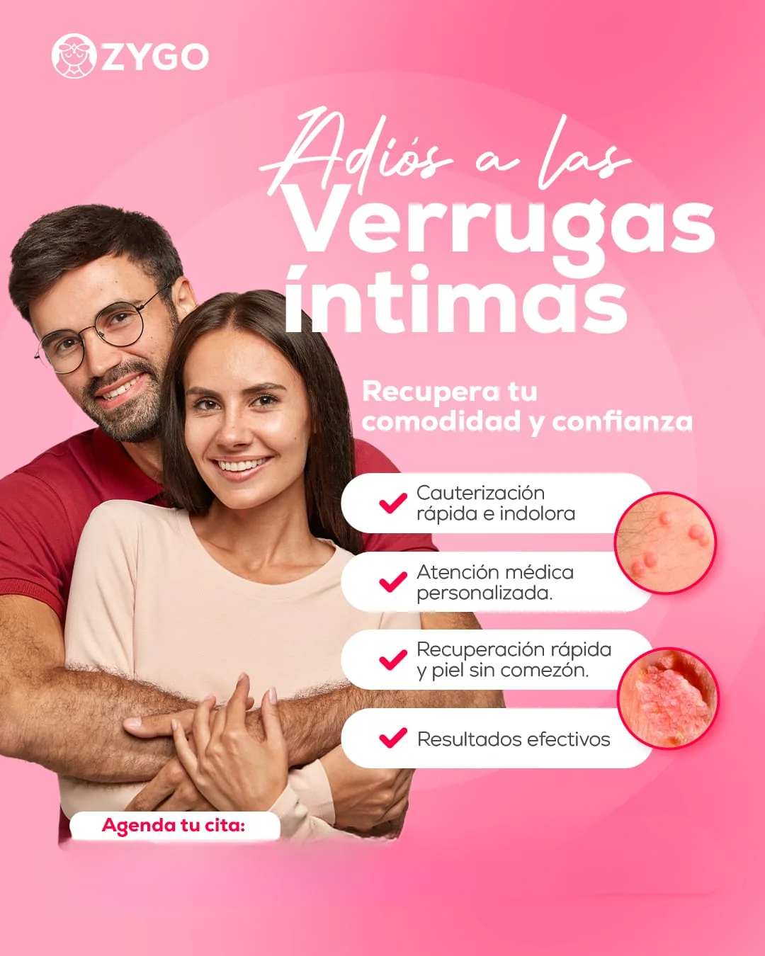 Verrugas Íntimas